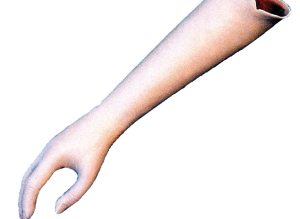 PROTHESE D’AVANT BRAS